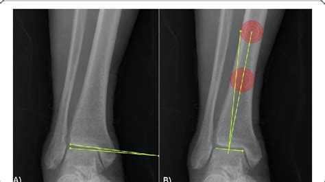 The Measurement Of Alignment Of The Right Ankle Joint Is Shown A Tilt