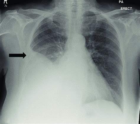 Chest X Ray Showed The Presence Of Right Sided Pleural Effusion