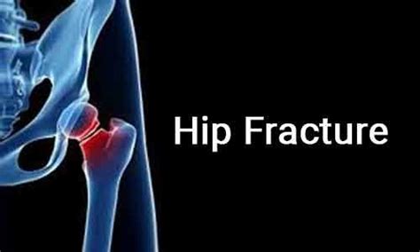 Peri Operative Management Of Hip Fracture Updated Aagbi Guidelines