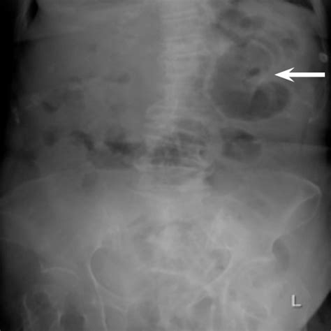 Pdf A Case Of Closed Loop Small Bowel Obstruction Within A
