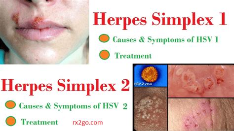As one of the most common sexually transmitted diseases, hsv requires our diligent attention. How To Treat Herpes Simplex? - Topic