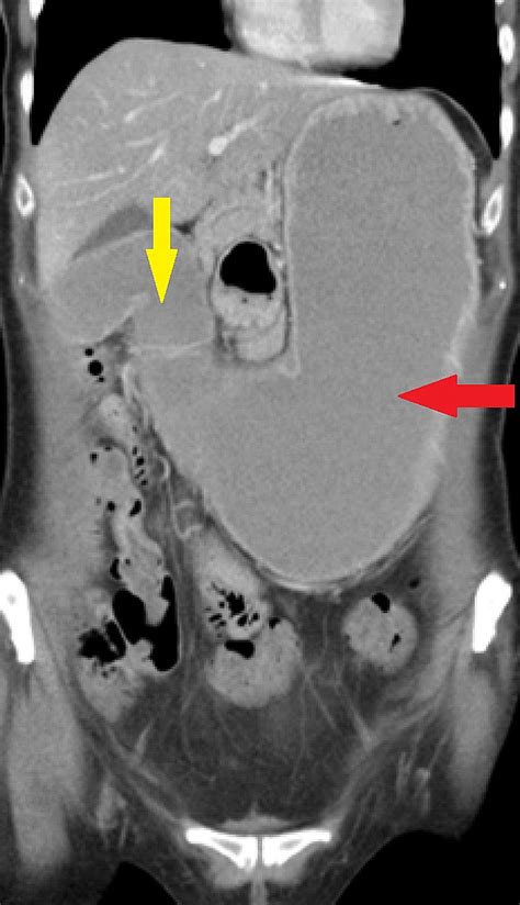Ct Scan Showing Grossly Distended Stomach Red Arrow With Thickening