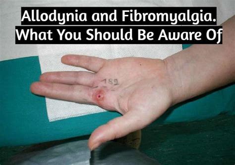 Allodynia And Fibromyalgia What You Should Be Aware Of With Images