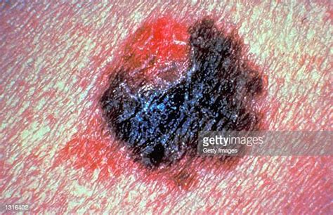 Malignant Melanoma Photos And Premium High Res Pictures Getty Images