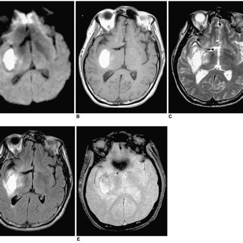 A 51 Year Old Man With Late Subacute Intracerebral Hematoma Seen On Mr