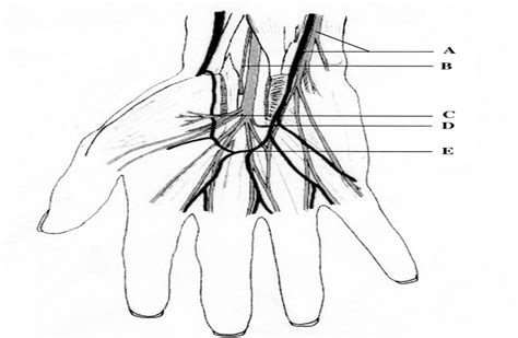 Carpal Tunnel Syndrome A Review Of Endoscopic Release Of Th