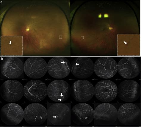 A Color Fundus Photographs Of Both Eyes At The First Visit A Magnified