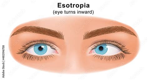 Squint Eye Strabismus Esotropia Eye Turns Inward Deflection Of