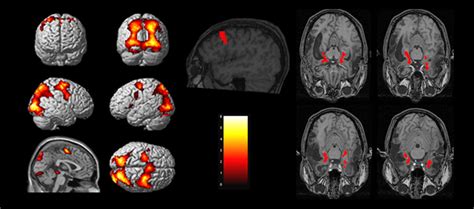 Fmri Vs Spect Scan For The Brain Cognitive Fx 2023