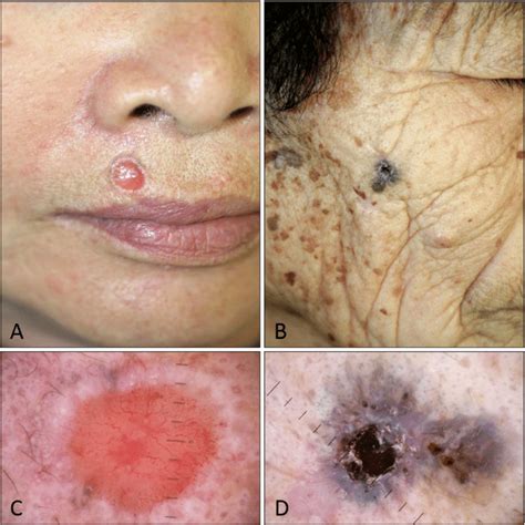 Clinical And Dermoscopic Photographs Of Squamous Cell Carcinoma Download Scientific Diagram