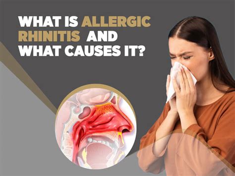 Treating Allergic Rhinitis From Seasonal Allergies King S Pharmacy And Compounding Center