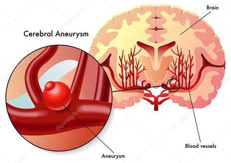 The most reliable test is called a diagnostic cerebral angiogram. aneurisma cerebral — Vetor de Stock © rob3000 #59877869