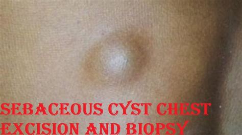 Sebaceous Cyst Of Chest Excision And Biopsy Cyst Near Breastdr