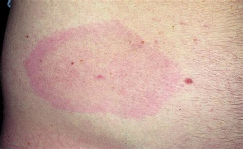 Erythema Chronicum Migrans The Cutaneous Features Of Lyme Disease