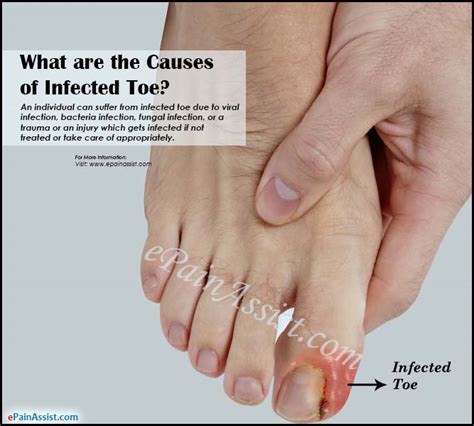 Infected Toe Causes Symptoms Treatment Diagnosis