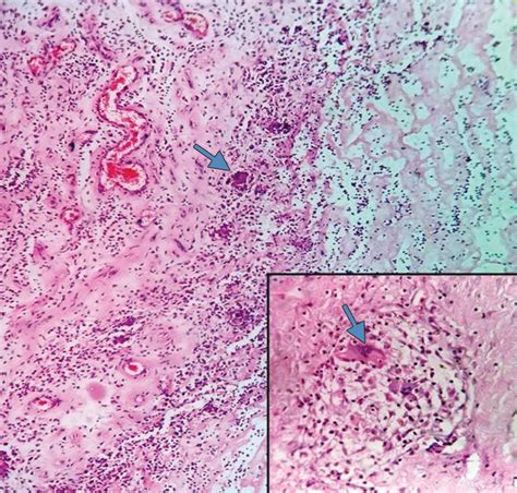 Peripheral Giant Cell Granuloma Histology