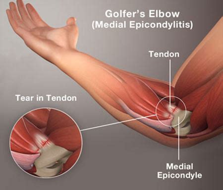 Gewehr Kalender Melodi S Tennis Elbow Medial Epicondylitis Huh