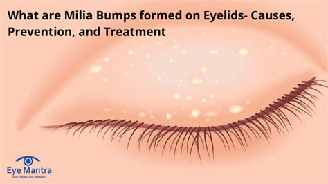 Eyelid Bump Types Causes And Treatment