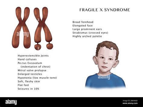 O Que é Sindrome Do X Fragil Edukita