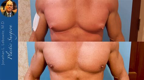 Before After Big Steroid Induced Gynecomastia Gland Removal By Dr
