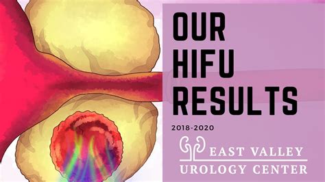 Check Out Our HIFU Results For Prostate Cancer Treatment At East Valley Urology Center In