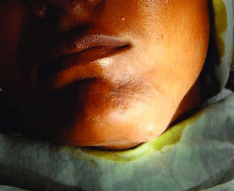Preoperative Clinical Appearance Of The Patient Showing Nodular