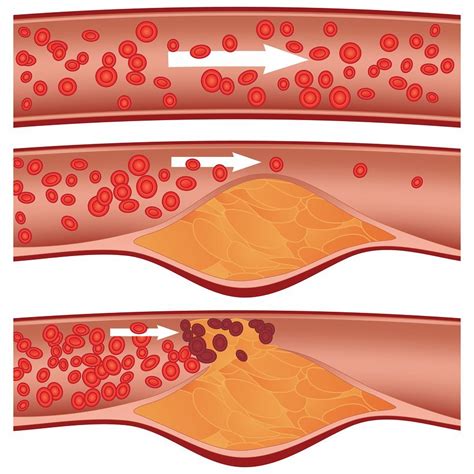 What Is Atherosclerosisdiagnosistreatment And Prevention