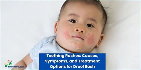 Drool Rash Causes Symptoms And Treatment