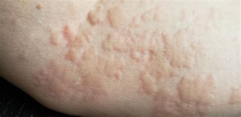 Allergic Reaction Bumps On Skin