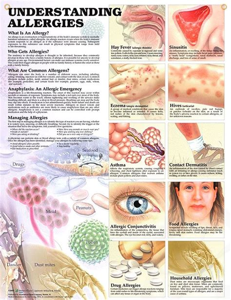 Understanding Allergies Chart 20x26 Most Common Allergies Allergies