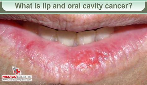 Lip And Oral Cavity Cancer Causes And Treatment