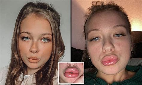 Mother Of Two Issues Stark Warning After Filler Ballooned Her Pout To Triple Its Size Daily