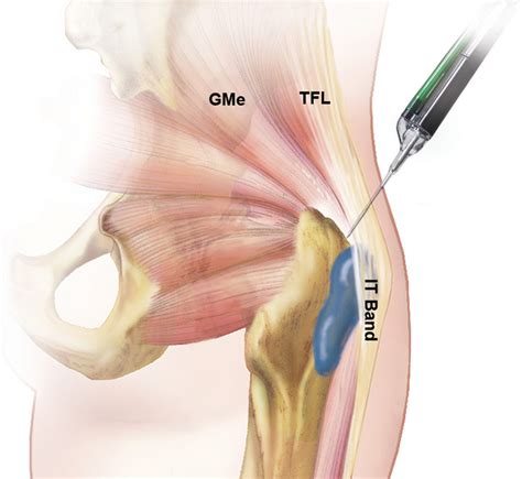 Dissolvenza Sua O Gluteus Medius Tendinitis Storia Formazione Scegliere