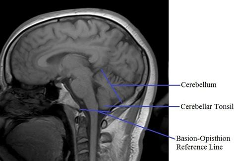 Cerebellar Peduncle Mri Anatomy