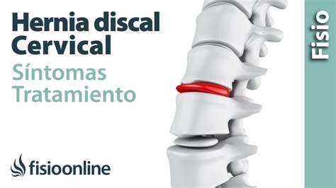 Hernia Discal O De Disco Cervical Qu Es Causas S Ntomas Y