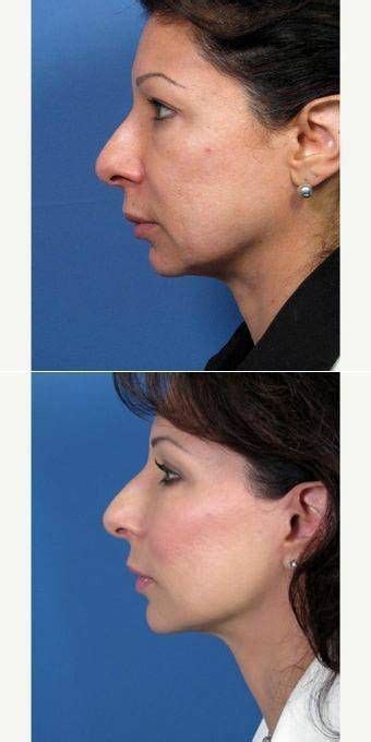 Facelift Neck Lift Surgery By Doctor John M Hilinski Md San Diego