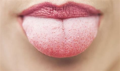 Si tenes la lengua blanca, podes tener alguno de estos problemas de salud