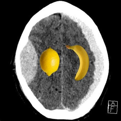 Epidural bleeding is rapid, usually from arteries (peak size at 6~8 hours). Resultado de imagen para subdural hematoma vs epidural ...