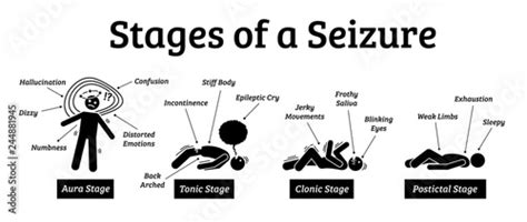 stages and phases of a seizure illustrations depicts the phases when a person get a seizure