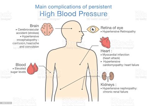 Main Complications Of Persistent High Blood Pressure Stock Illustration