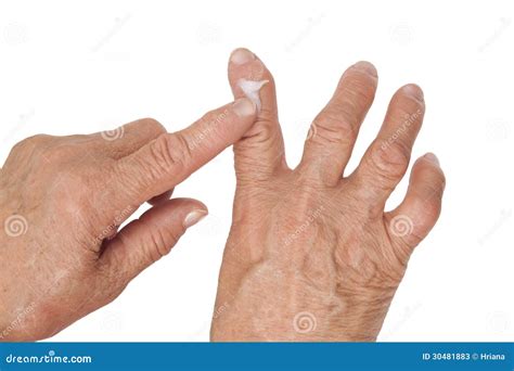 Artrite Reumatoide Dos Dedos Usando O Creme Médico Imagem De Stock