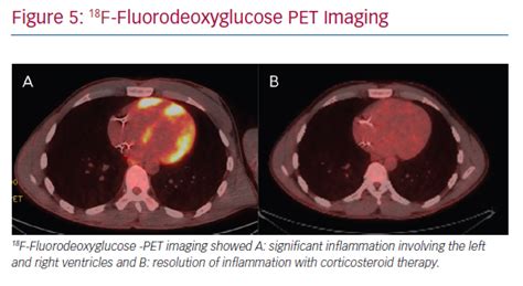18f Fluorodeoxyglucose Pet Imaging Radcliffe Cardiology
