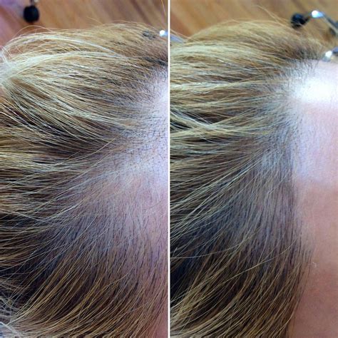 After confirming with a medical specialist that your condition is actually receding hairline and not a kind of alopecia, you may look for topical creams which can. What Is Scalp Microblading? Everything You Need to Know ...