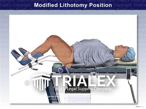 Modified Lithotomy Position Trial Exhibits Inc