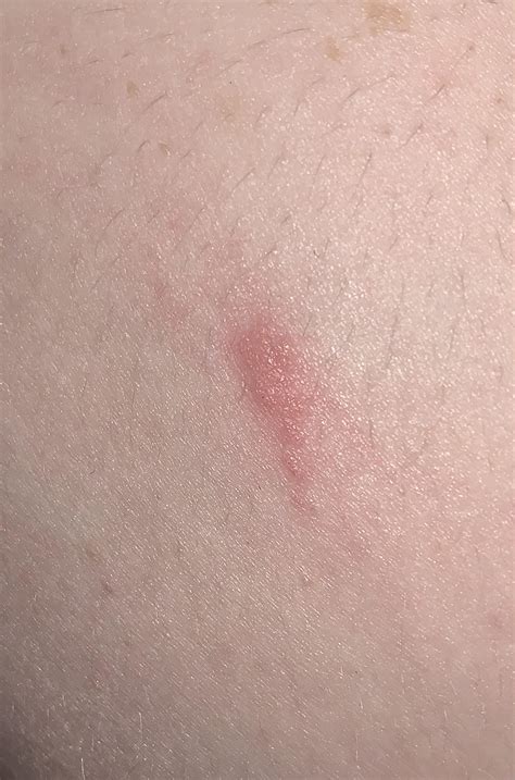 Does This Look Like A Post Scabies Rash Or An Active Infestation R