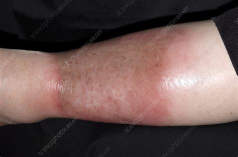 Infected Varicose Eczema Stock Image M1500337 Science Photo Library