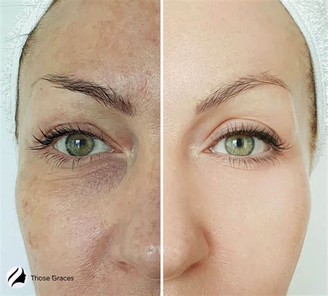 5 Before And After Microdermabrasion Stunning Results Videos