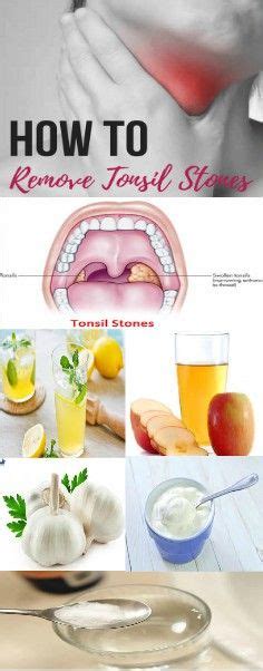 Boost Flow How To Get Rid Of Tonsil Stones