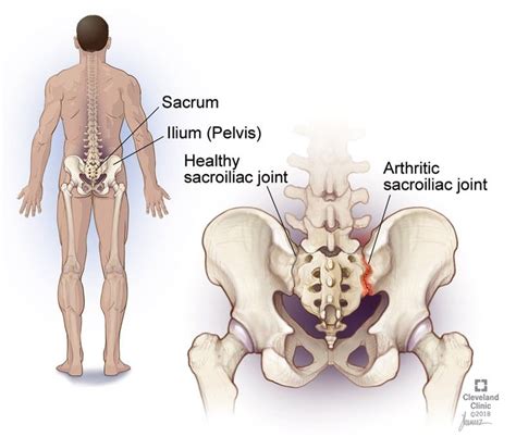 Back Pain Symptoms Causes Of Back Pain Inflammatory Arthritis Psoriatic Arthritis