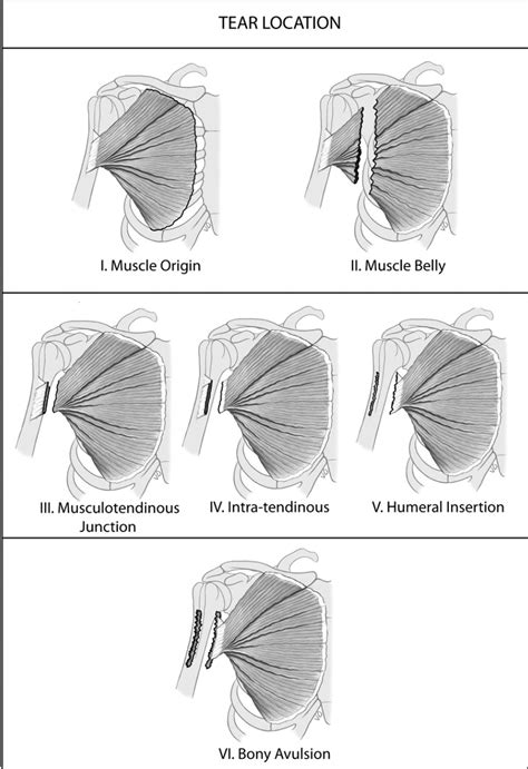 Pectoralis Major Rupture Shoulder And Elbow Orthobullets